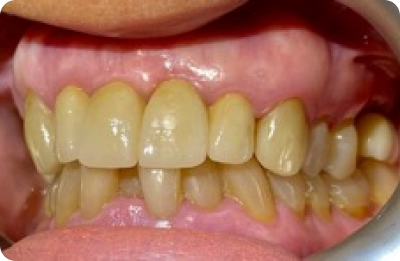 protesi_dentaria